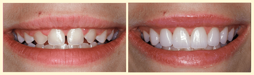 before-and-after emax veneer 2