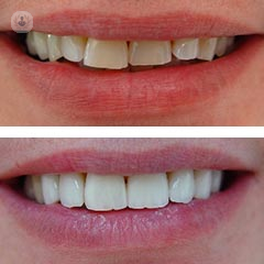 before-and-after emax veneer solihull
