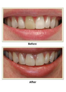 before-and-after emax veneer 5