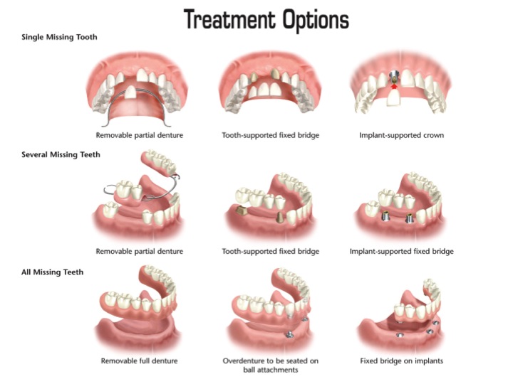 Several Before and And After best dental implants