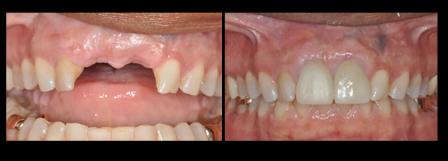 before and after multiple implants