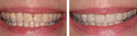 before-and-after emax veneer 3