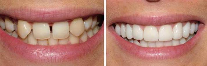 before-and-after emax veneer 4