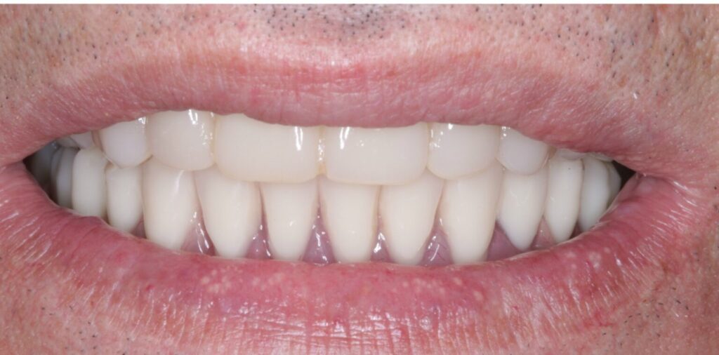 Denture Supported By Implants 1