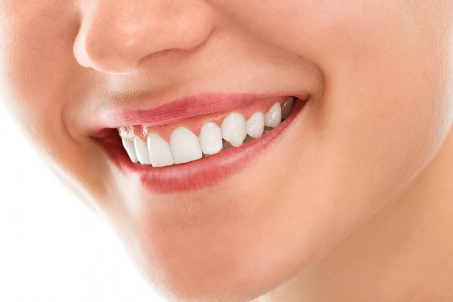 emax veneer