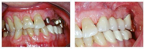 multiple implants Before and After 1
