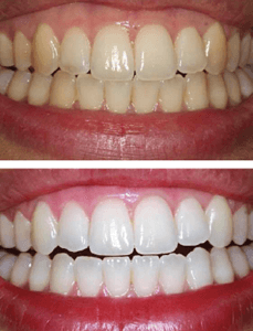 porcelain-veneers-after-and-before