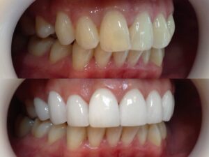 porcelain-veneers-after-and-before 1