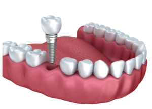 single-dental-implant