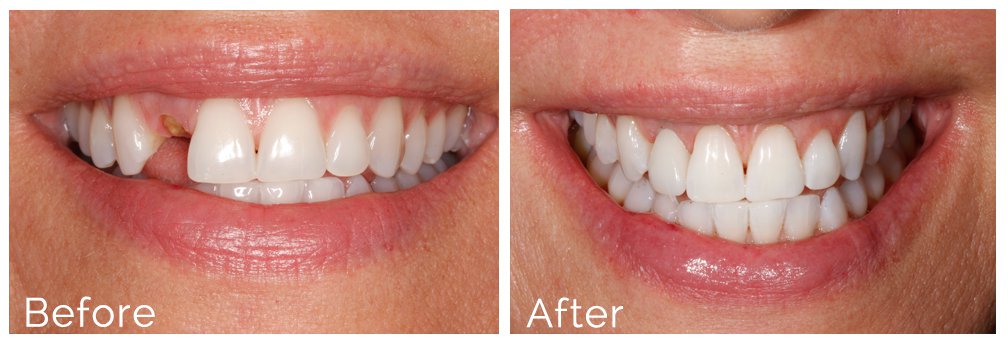 single implant Before and After