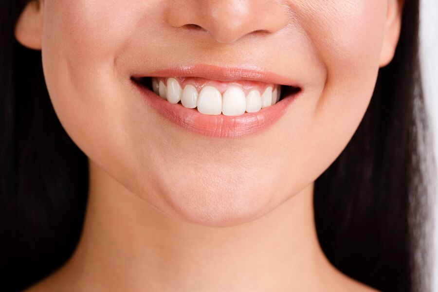 emax veneer solihull