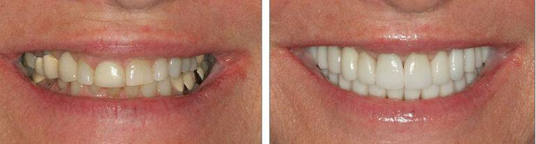 before after teeth whitening solihull