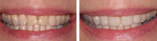 before after teeth smile makeover solihull birmingham