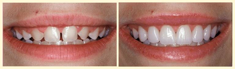 before after teeth bonding solihull