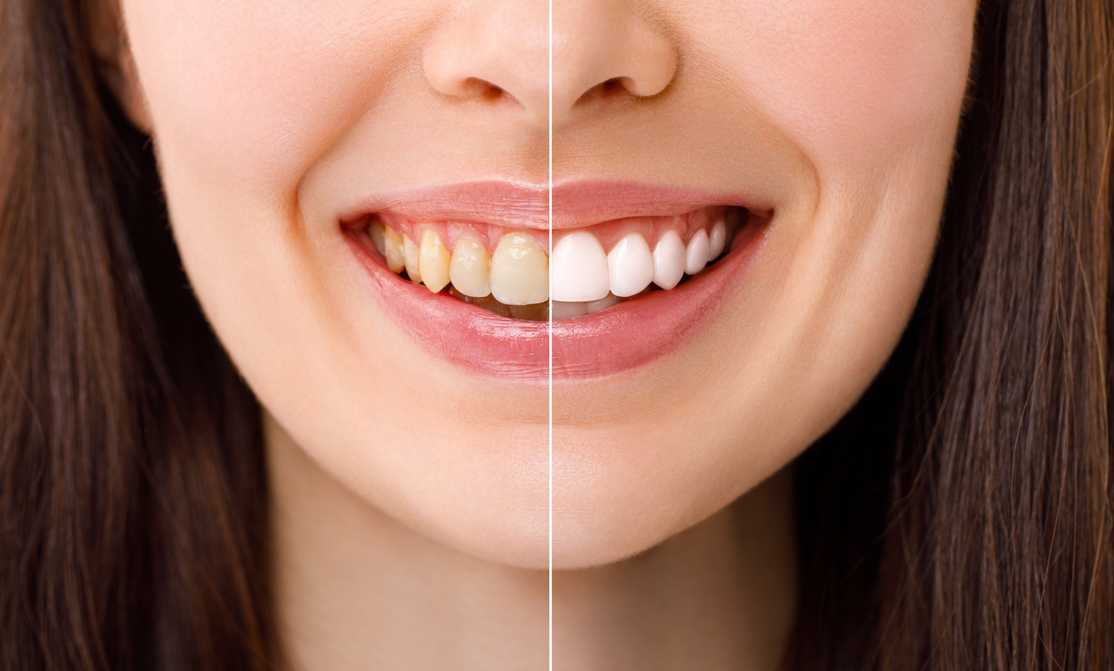 before after teeth whitening