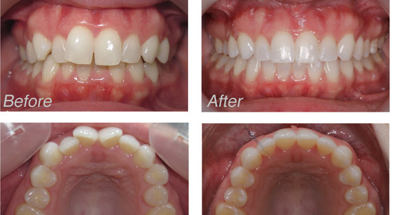 before and after invisalign braces