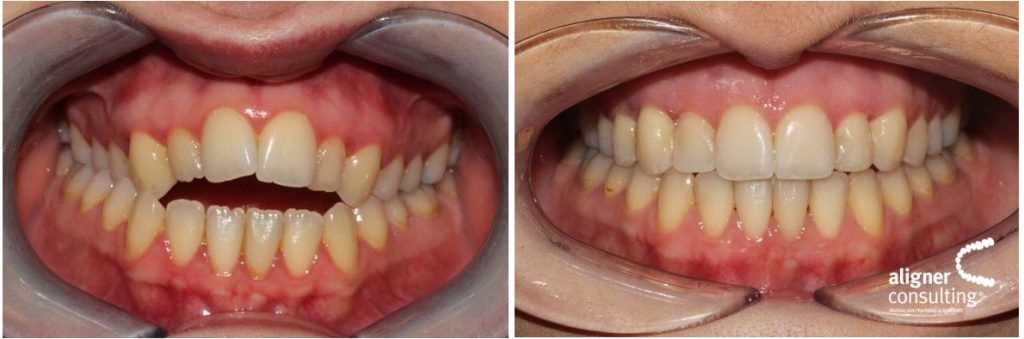 before after invisalign braces solihull