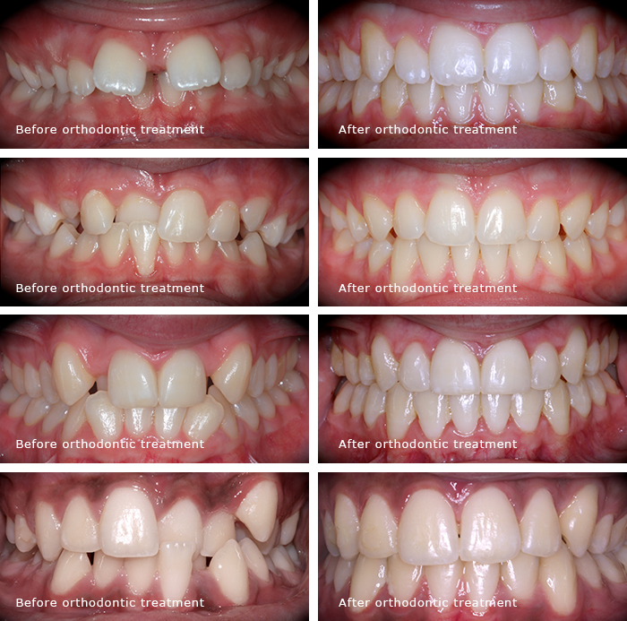 before after invisalign braces