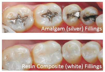 before and after safe amalgam removal