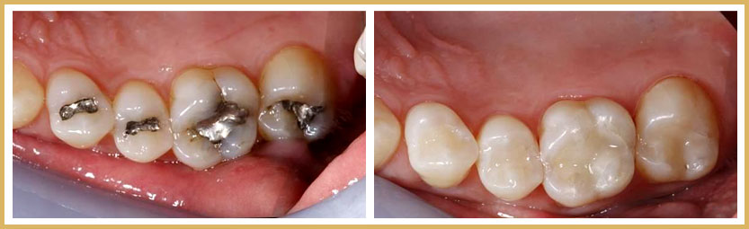before and after safe amalgam removal procedure