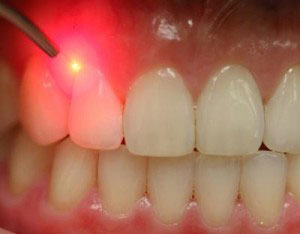 laser periodontal treatment