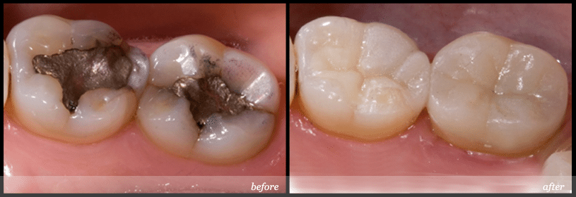 before and after safe amalgam removal 1