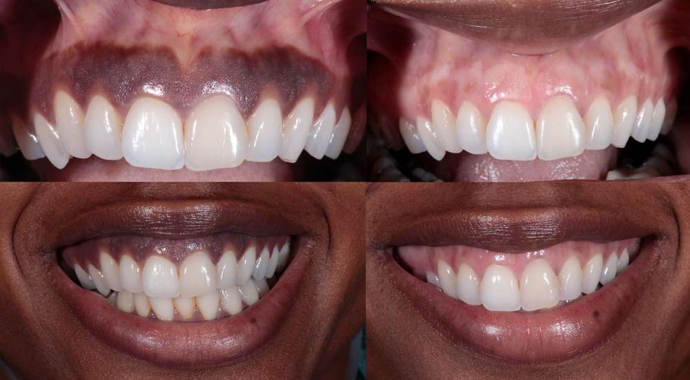 2 different pictures of before and after gum pigmentation