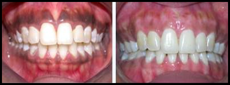 before and after gum pigmentation 3