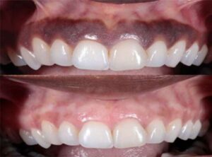before and after gum pigmentation 2
