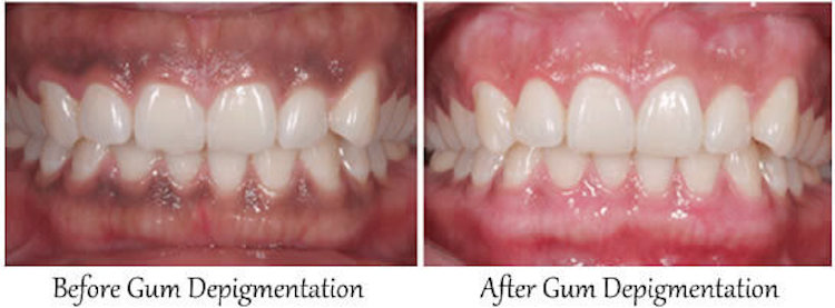 before and after gum pigmentation