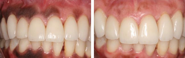 pigmentation-before-and-after-2