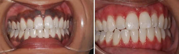 before and after gum pigmentation