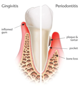 Gum-Disease-birmingham