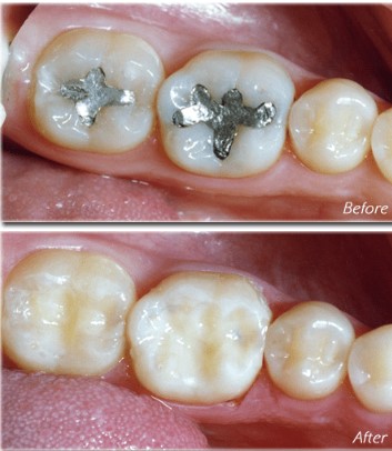 amalgam_safe_removal_ silver_filling before and after
