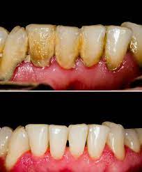 gum disease laser treatment Birmingham